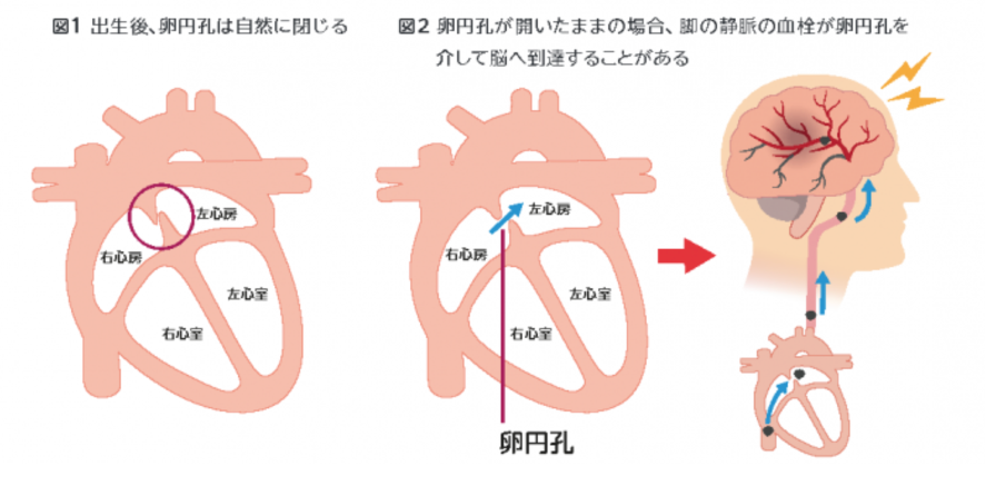 卵円孔の図